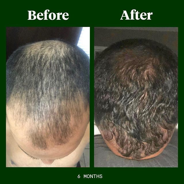 4 Tips for Male Hair Loss - Review Therapy